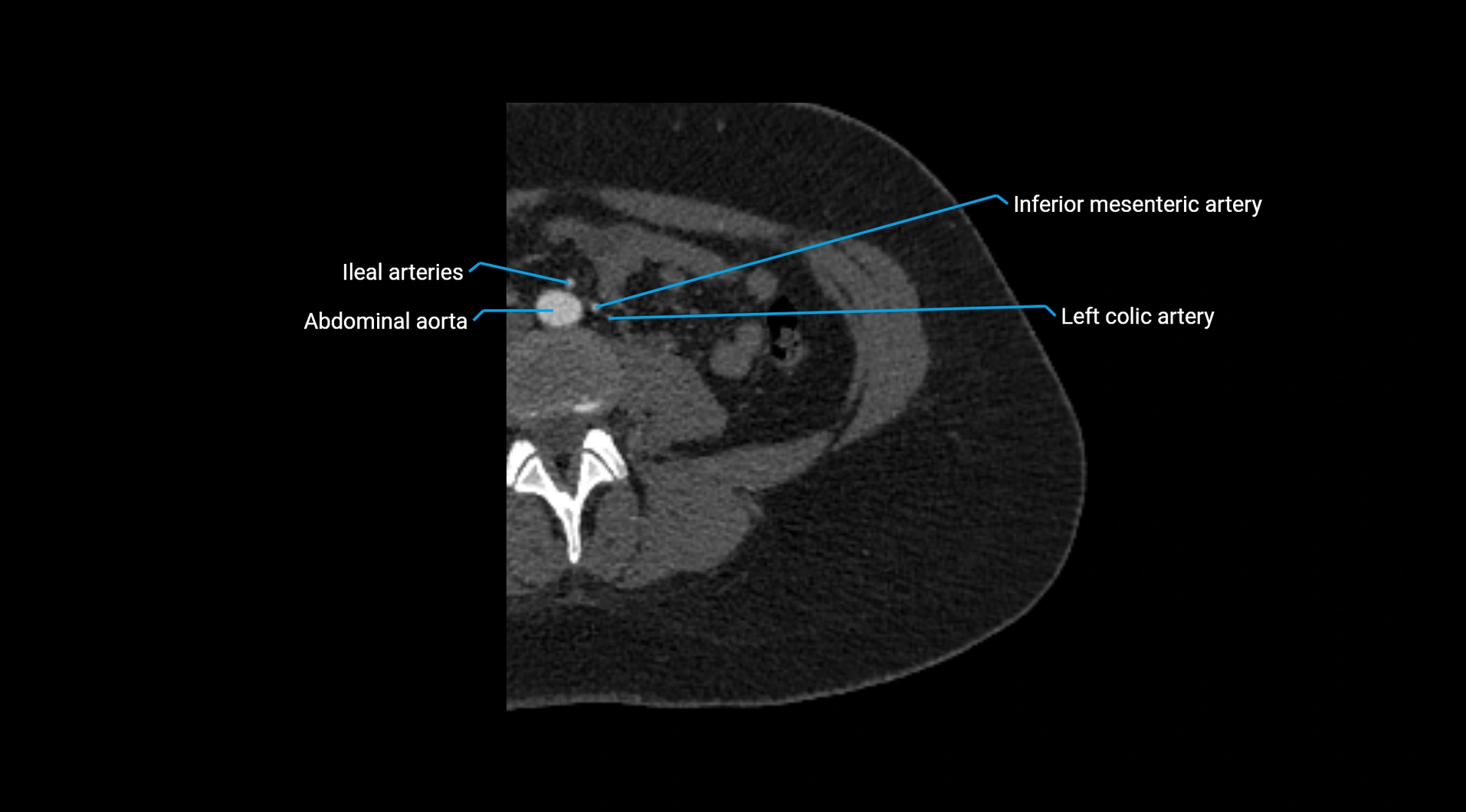 CTA lower limb cross sectional anatomy labelled image _1.webp